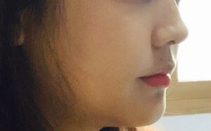 양악수술 후기