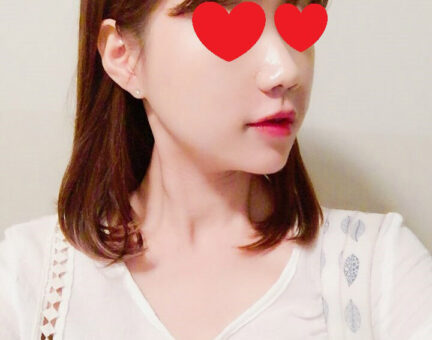<< 양악 + 광대 + 브이라인 수술 후기입니다 >>