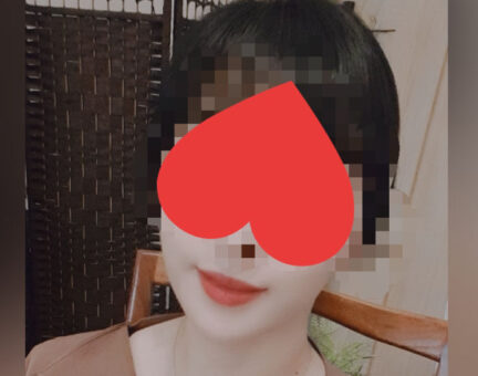 양악2년후 핀제거를 앞두고