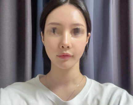 양악수술 6개월후기